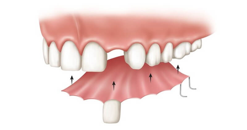 Съемный протез на передние зубы