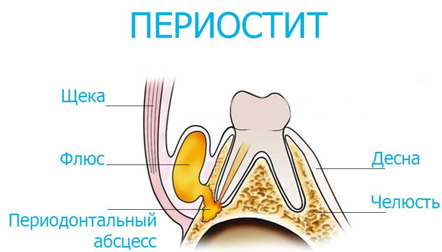 Лечение периостита