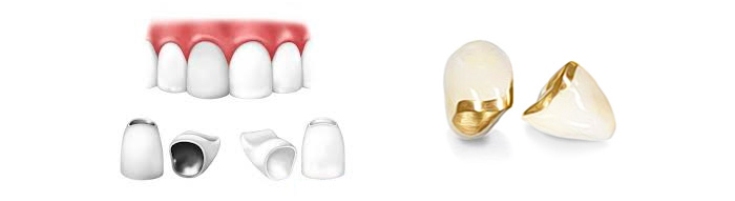 Новые стоматологические материалы для лечения стираемости зубов
