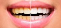 Отбеливание и устранение дисколорита зубов