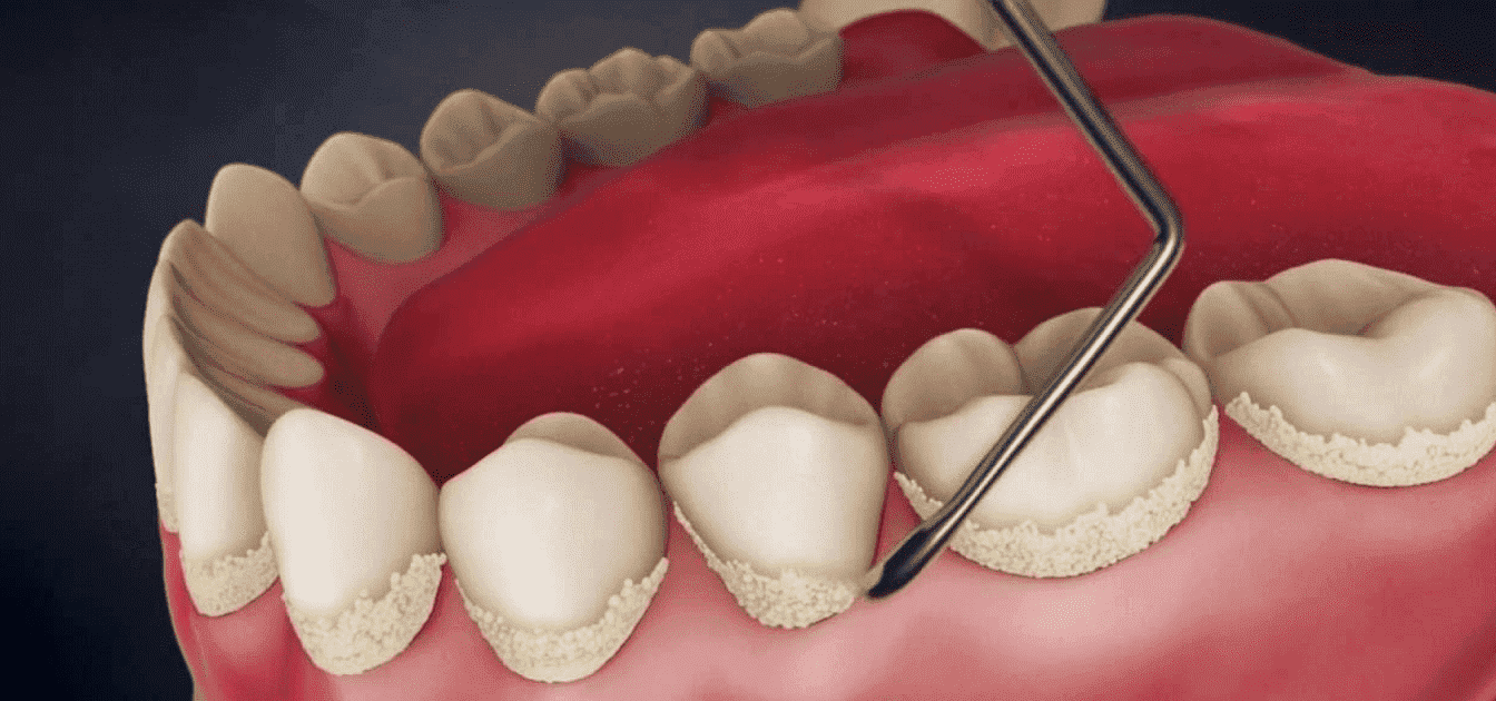Причины образования зубного камня и пародонтита